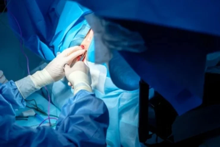 Fissure Surgery