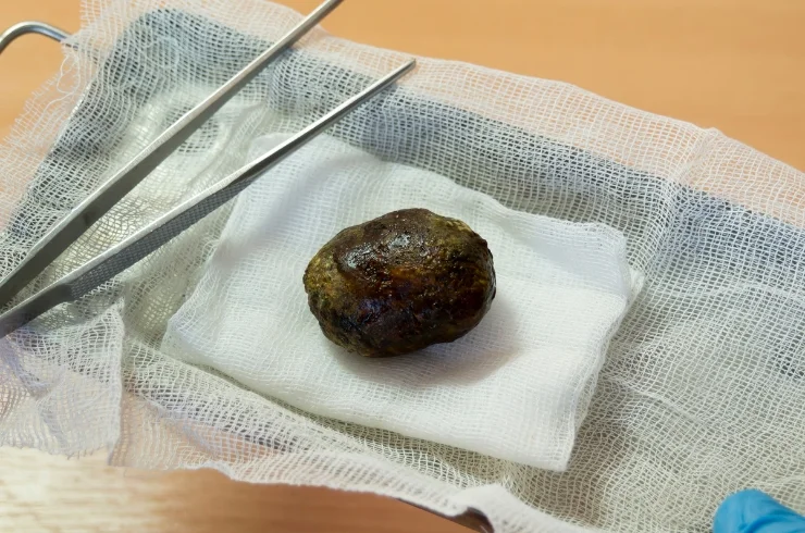 Gall Bladder Stone Surgery